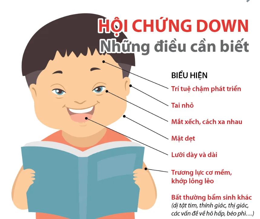 Hội chứng Down có mấy loại