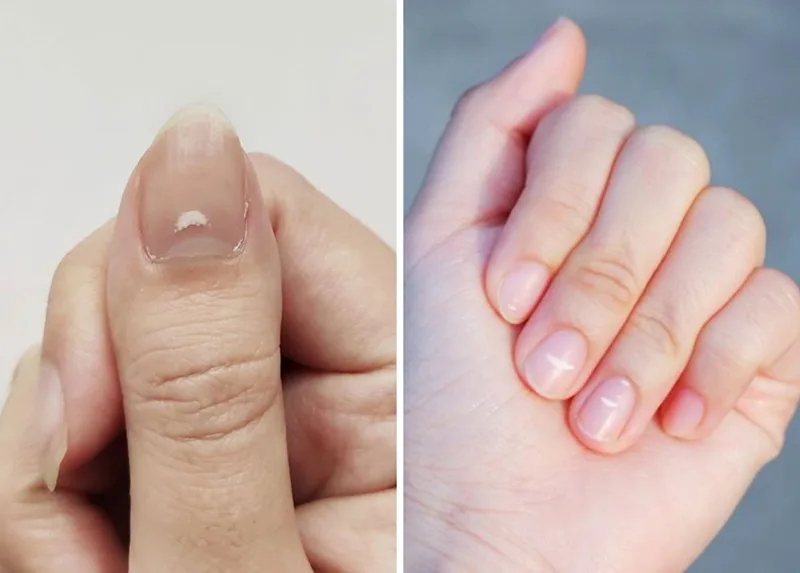 Hiện tượng vệt trắng trên móng tay (Leukonychia) xuất phát từ sự xáo trộn cấu trúc keratin.