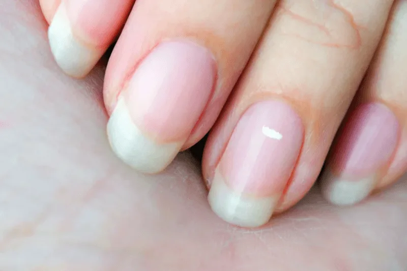 Thiếu hụt các vi chất dinh dưỡng thiết yếu như kẽm và canxi khiến móng dễ nổi đốm trắng.