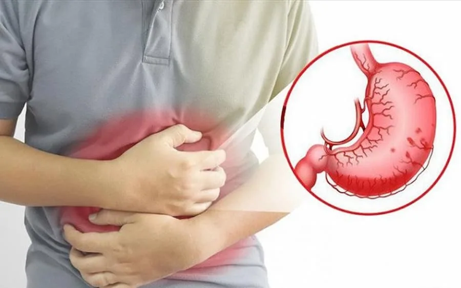 Vi khuẩn HP dạ dày có lây không