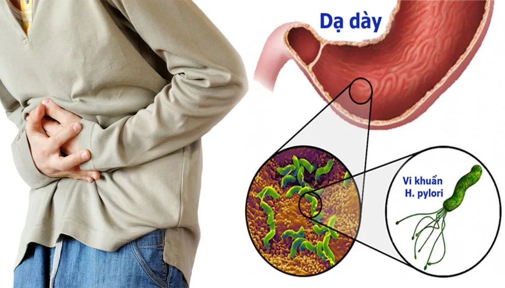 Vi khuẩn HP dạ dày có lây không