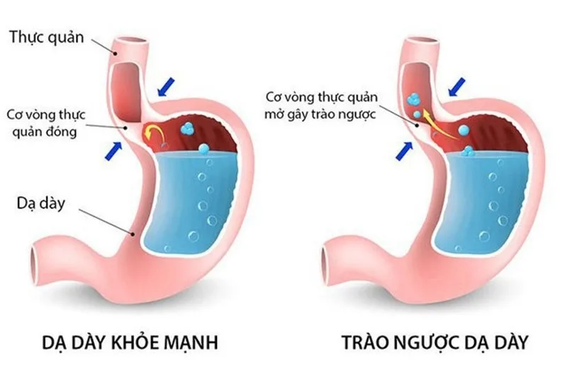 Cơ chế gây trào ngược dạ dày do sự suy yếu của cơ vòng thực quản.